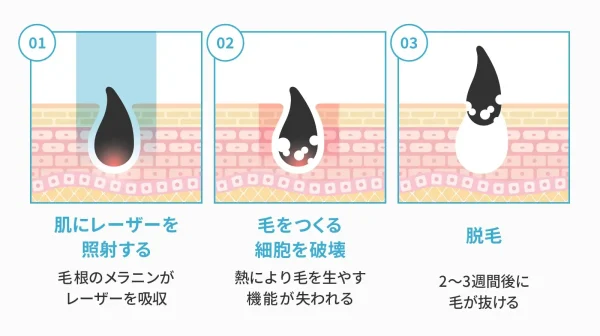 医療レーザー脱毛の仕組み