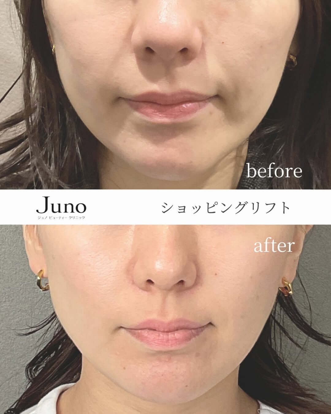 ジュノビューティークリニックで行ったショッピングリフトの症例写真