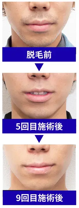 ヒゲ脱毛を施術した経過の写真