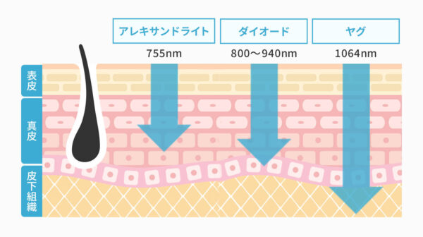 アレキサンドライトレーザー、ダイオード、ヤグ