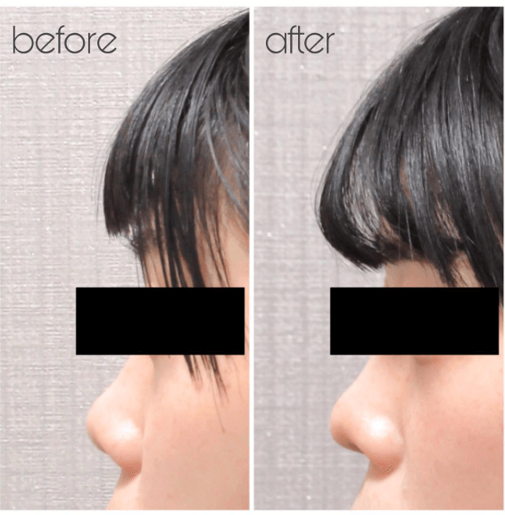 耳介軟骨移植という鼻整形を実際に経験した人の症例写真