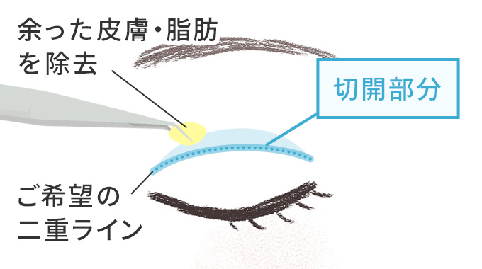 切開法の図版。余った皮膚・脂肪を除去したりご希望の二重ラインを表しています。