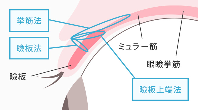 瞼板法と挙筋法を図版で解説しています。