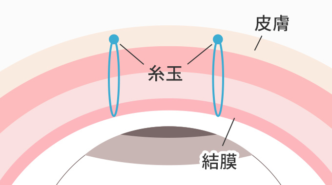 表留めを説明した画像