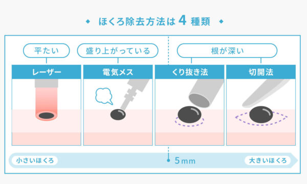 ほくろ除去方法は4種類あり、それを図版でわかりやすく表しております