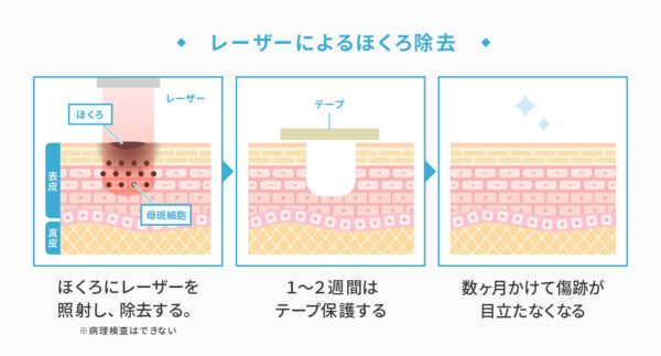 レーザーによるほくろ除去による変化の様子