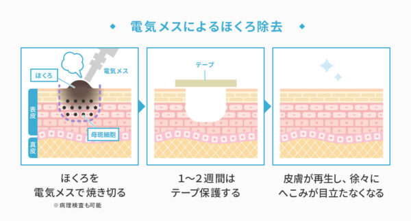 電気分解法（電気メス）…小さくて盛り上がったほくろのある人向きを表した図版