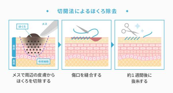 切開法によるほくろ除去による変化の様子