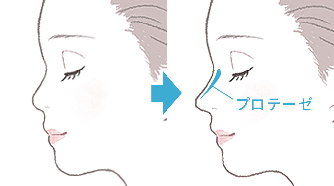 隆鼻術の図版です。プロテーゼを記しています。