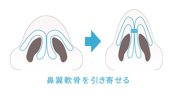 鼻翼軟骨を引き寄せる