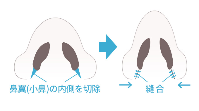 鼻翼の内側を切除し、縫合をします