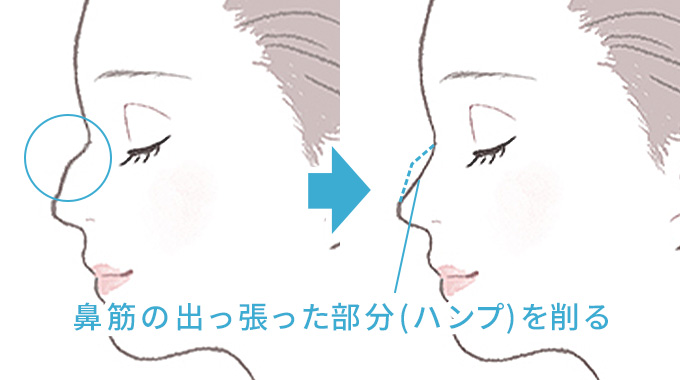 鼻筋の出っ張った部分を削ります