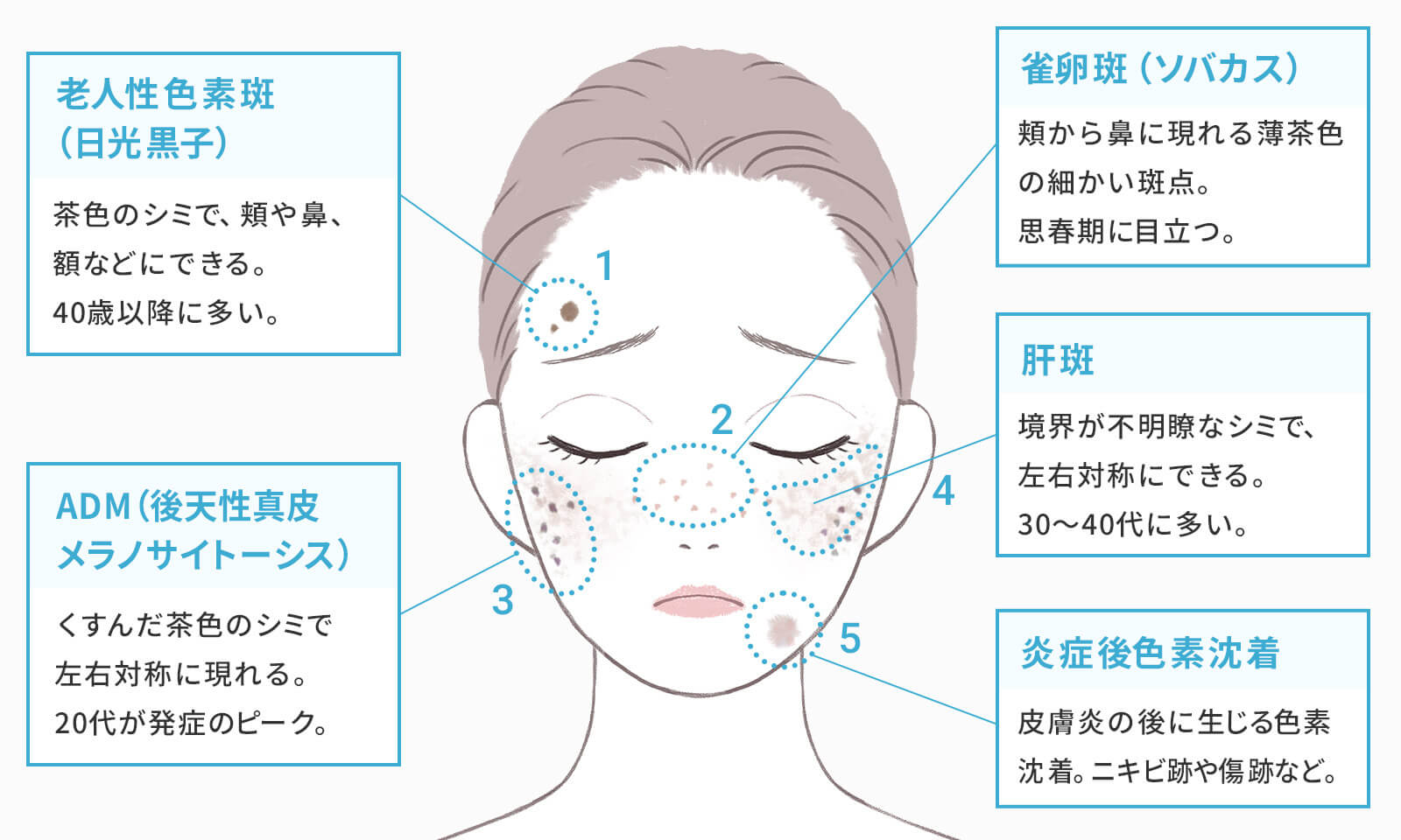 シミの5種類の図版。老人性色素斑・そばかす・ADM・肝斑・炎症後色素沈着