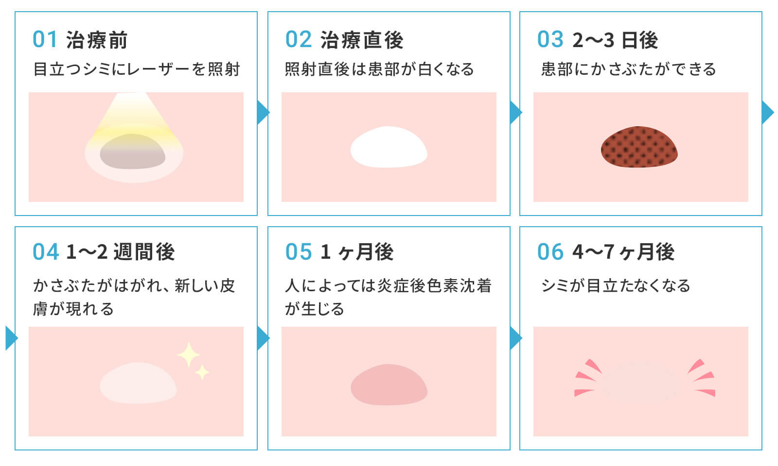 シミ取りレーザーの治療後の経過画像です。治療前から治療後、2~3日後、1~2週間後、1ヶ月後、4~7ヶ月後までの経過画像です。詳しくは下で解説しています。