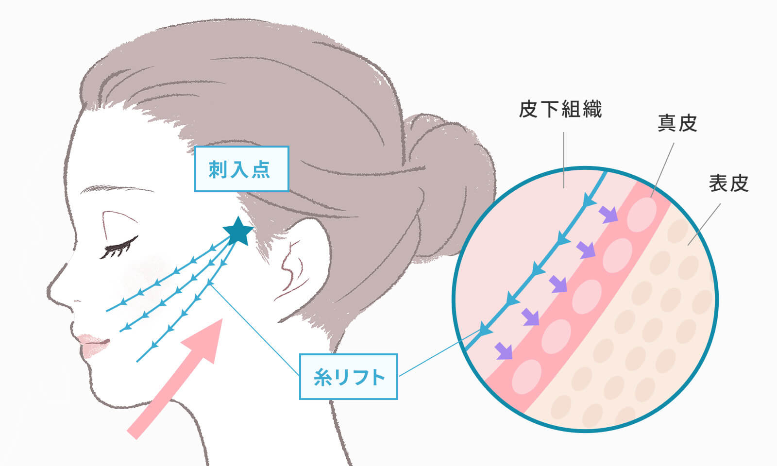 糸リフト治療の概要を図に表しました。
こめかみ付近の生え際から特殊な糸を挿入して皮膚や皮下組織を持ち上げ、顔のシワやたるみを改善する治療法です。