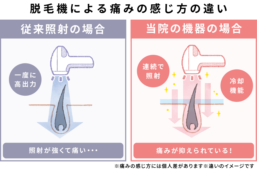 脱毛機による痛みの感じ方の違いの図。従来照射の場合、一度に高出力で照射が強くて痛い。最新機器の場合、連続照射と冷却機能で痛みが抑えられる。