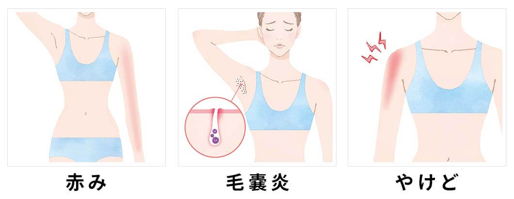 赤みや毛嚢炎、やけどなど脱毛で起きるかもしれない肌トラブルの図
