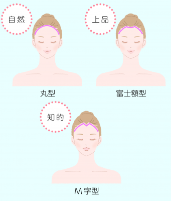 髪の生え際の例