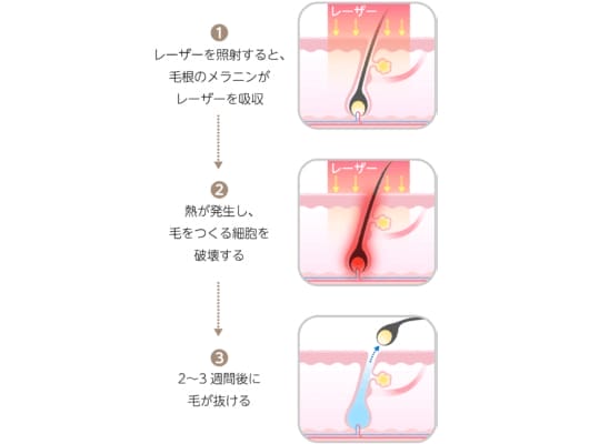 医療脱毛で毛が抜ける仕組み
