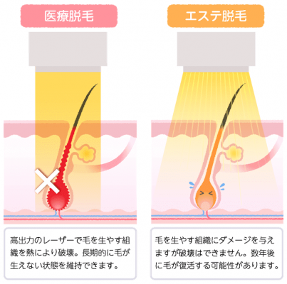 エステ脱毛と医療脱毛の違い