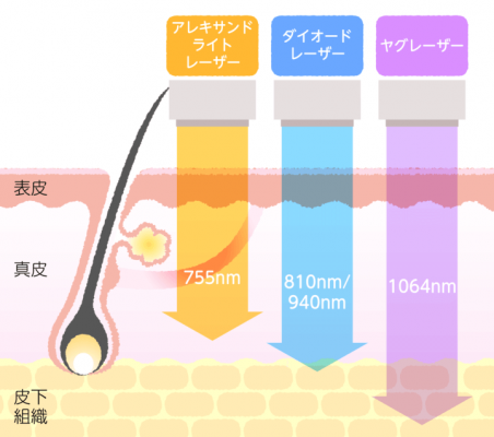 アレキサンドライトレーザーと他のレーザーの比較した画像