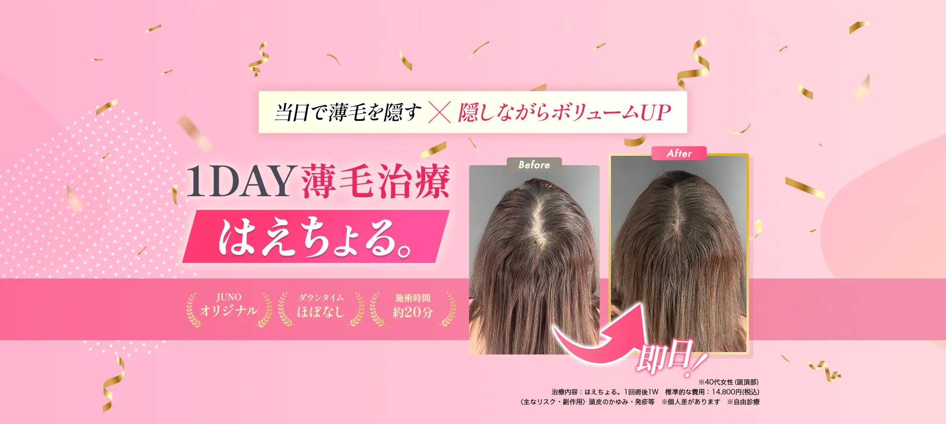 即日で隠すx隠しながら生やす1day薄毛治療はえちょる。