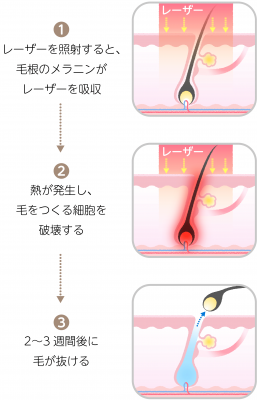 ヤグレーザー脱毛の仕組み