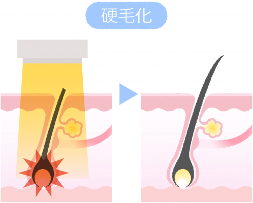 背中の硬毛化や増毛化