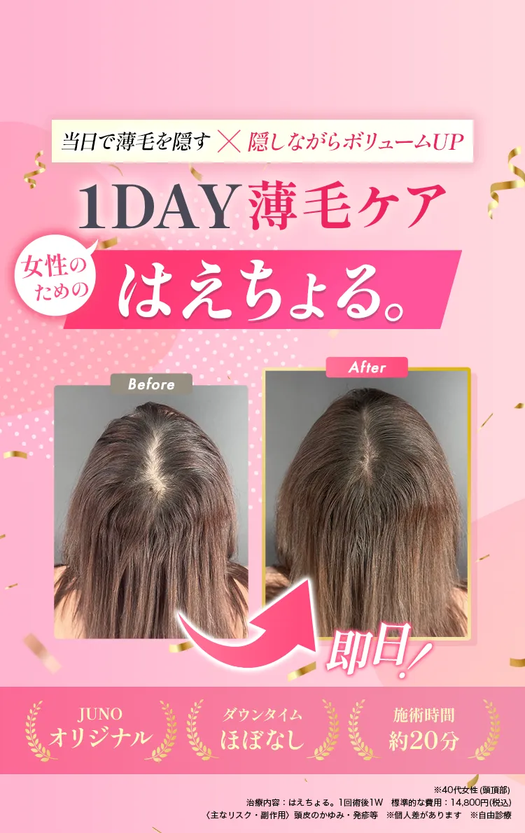 即日で隠すx隠しながら生やす1day薄毛治療はえちょる。